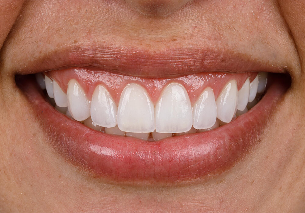 Smile transformation after cosmetic veneers treatment