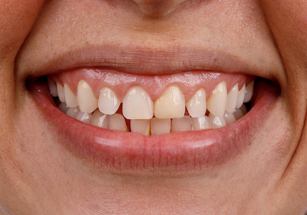 Smile transformation before cosmetic veneers treatment